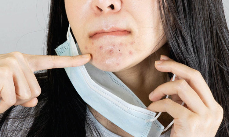 ¡No pierdas tu belleza! 5 consejos para evitar el acné que causa la mascarilla