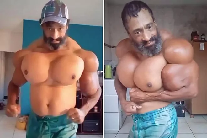 Murió el «Hulk brasileño», el culturista que se inyectó aceite para hacer crecer sus músculos